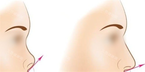 長沙亞韓整形趙貴慶怎么樣?鼻修復技術贊,歪鼻矯正自然,術后不懼揉捏超安心！